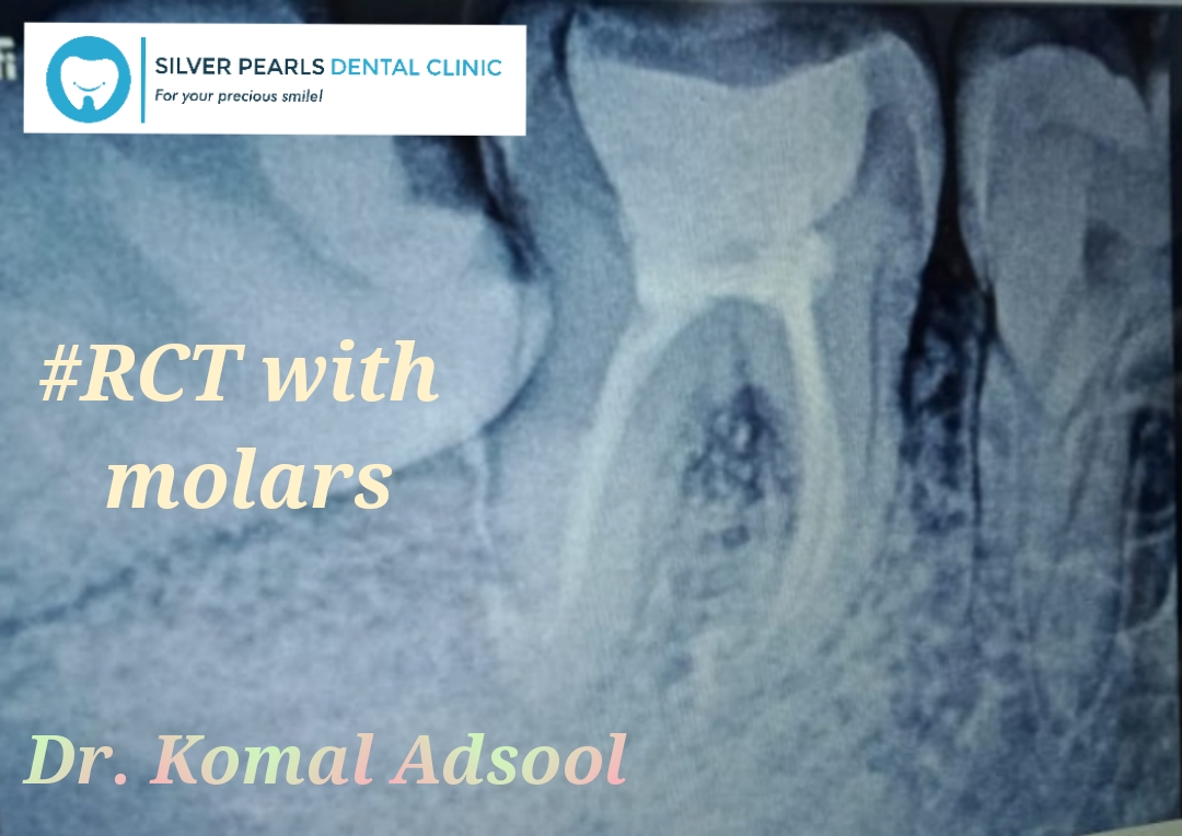 Root canal treatment of molars by our dentist in Kothrud, Dr. Komal Adsool.