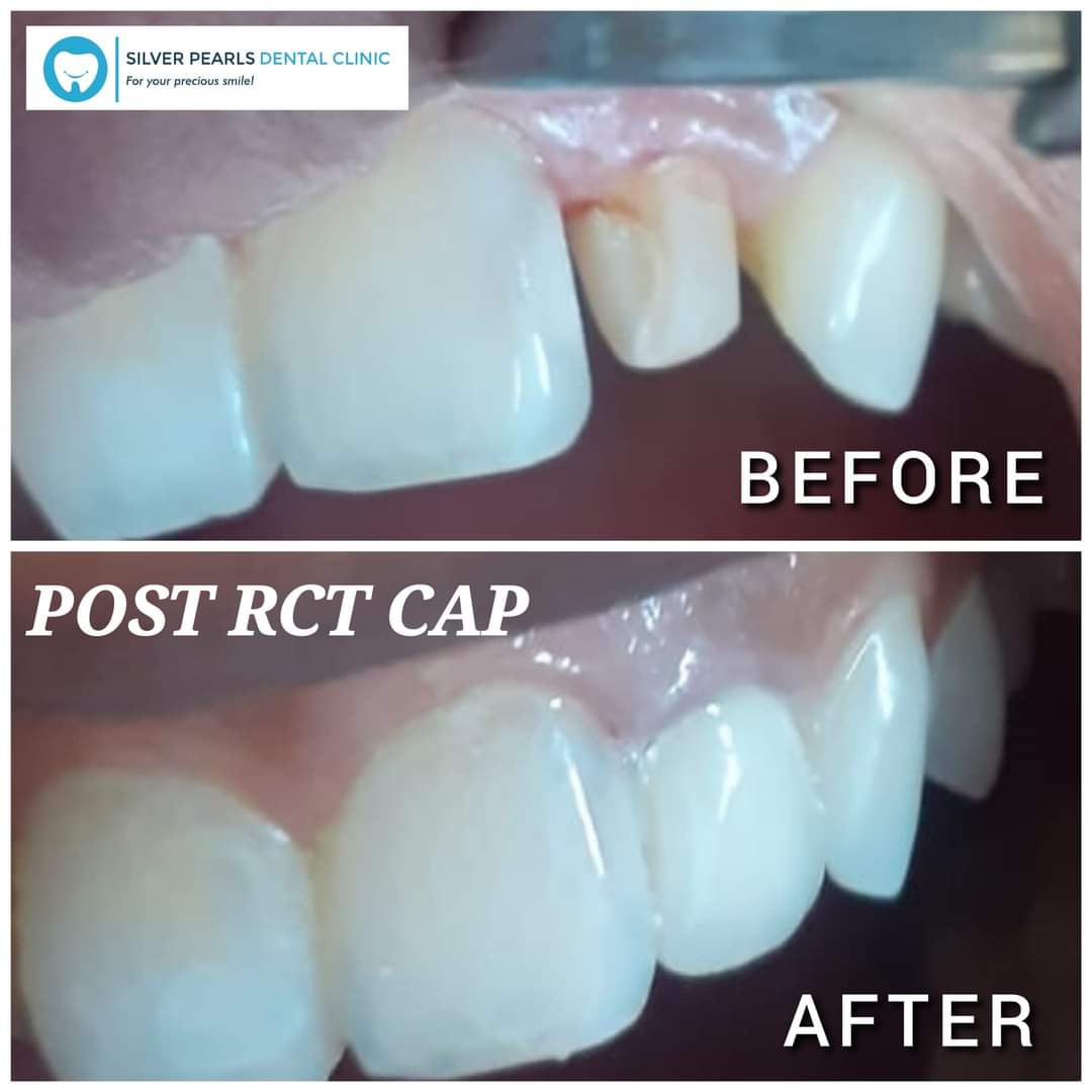 Ceramic crown fitted after root canal treatment by our dentist in Kothrud, Dr. Komal Adsool.