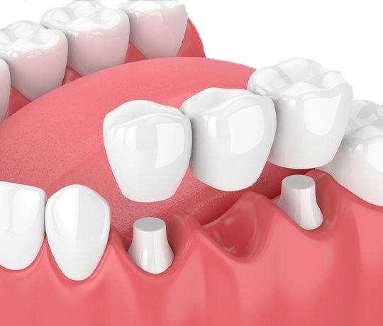 Image of dental bridges