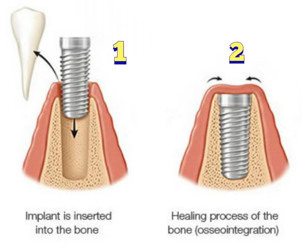 Dental implants procedure steps 1 & 2