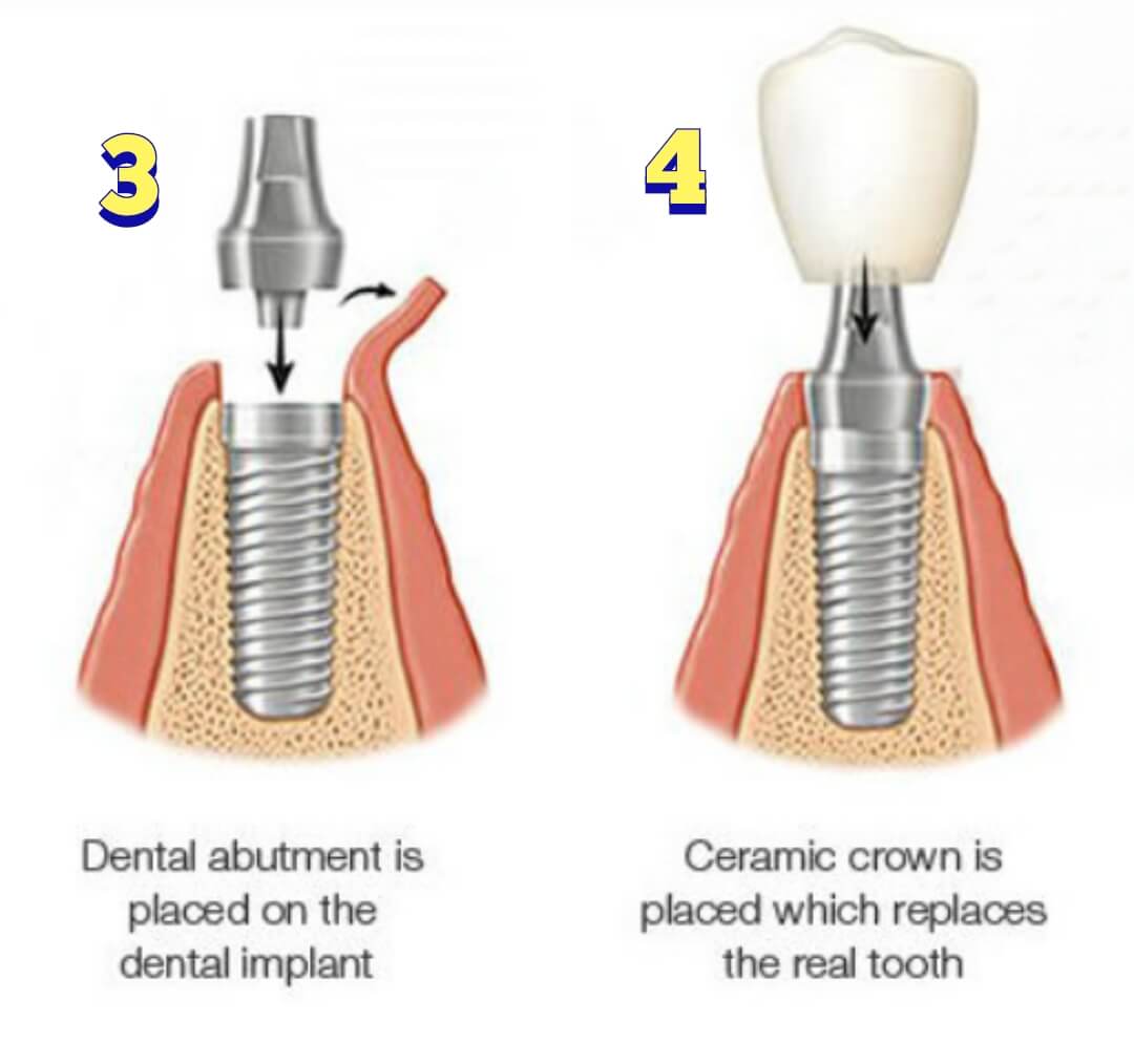 Dental implants procedure steps 3 & 4