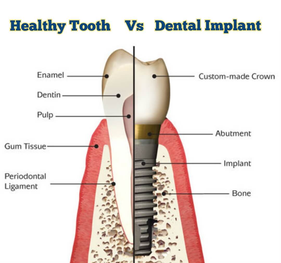 Happy Tooth vs Dental Implant