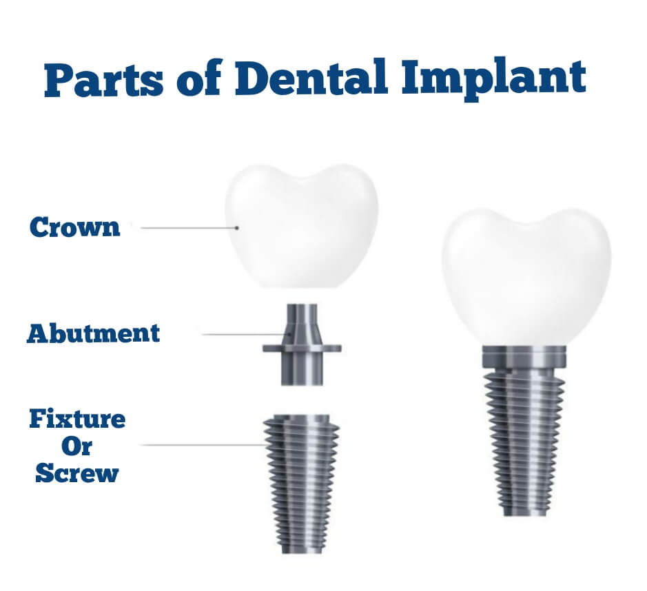 Parts of the Dental Implant