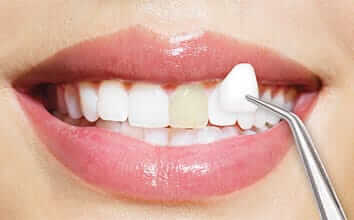 Image of Porcelain Veneers