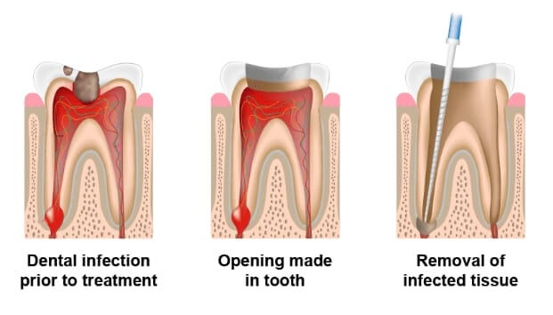 Root canal treatment procedure steps 1, 2 & 3