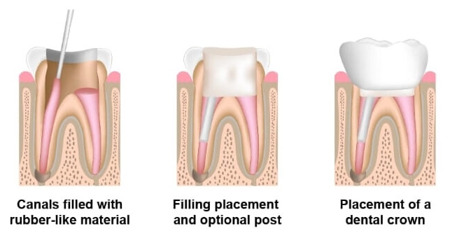 Root canal treatment procedure steps 4, 5 & 6