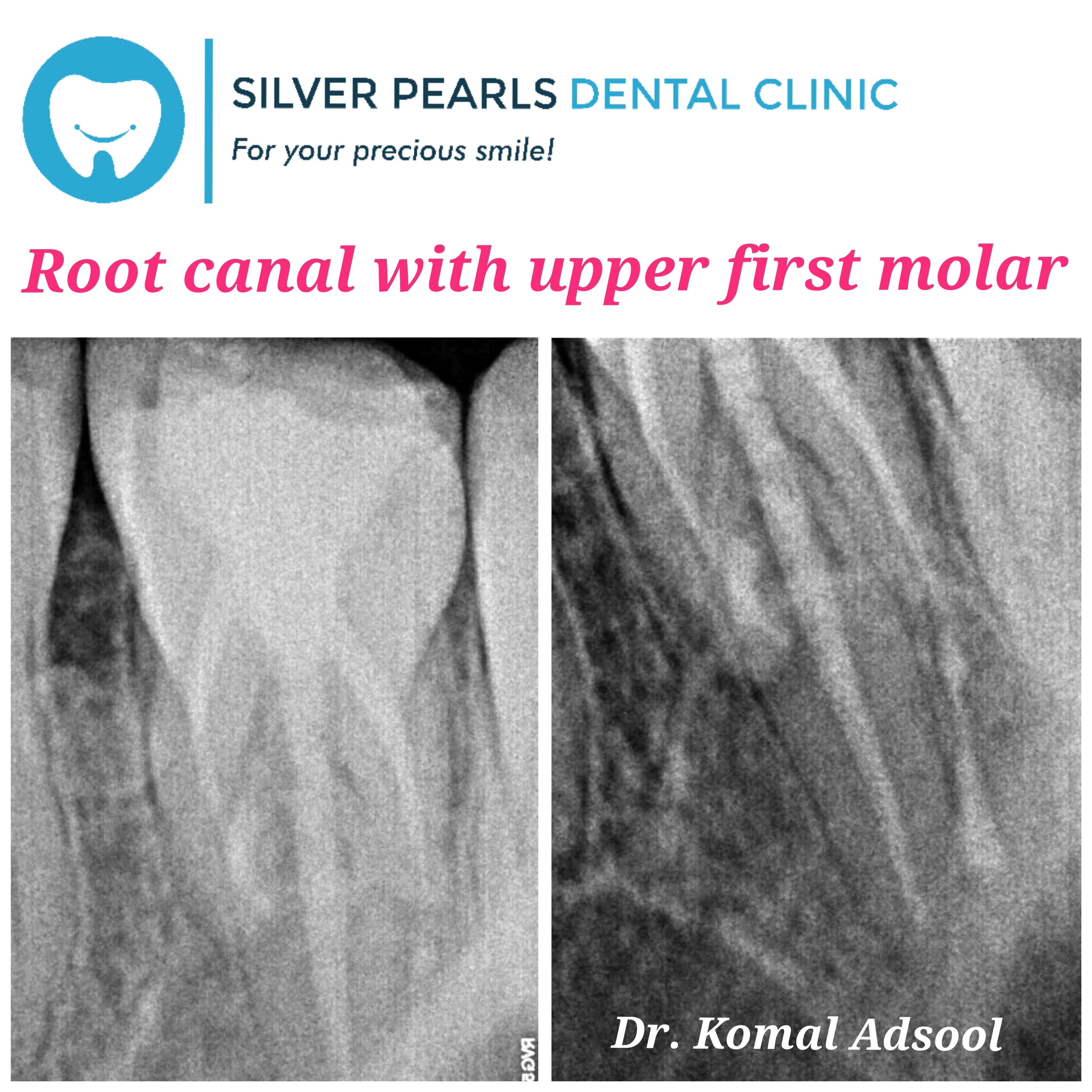 Root canal treatment with upper first molar by dentist in Kothrud, Dr. Komal Adsool.