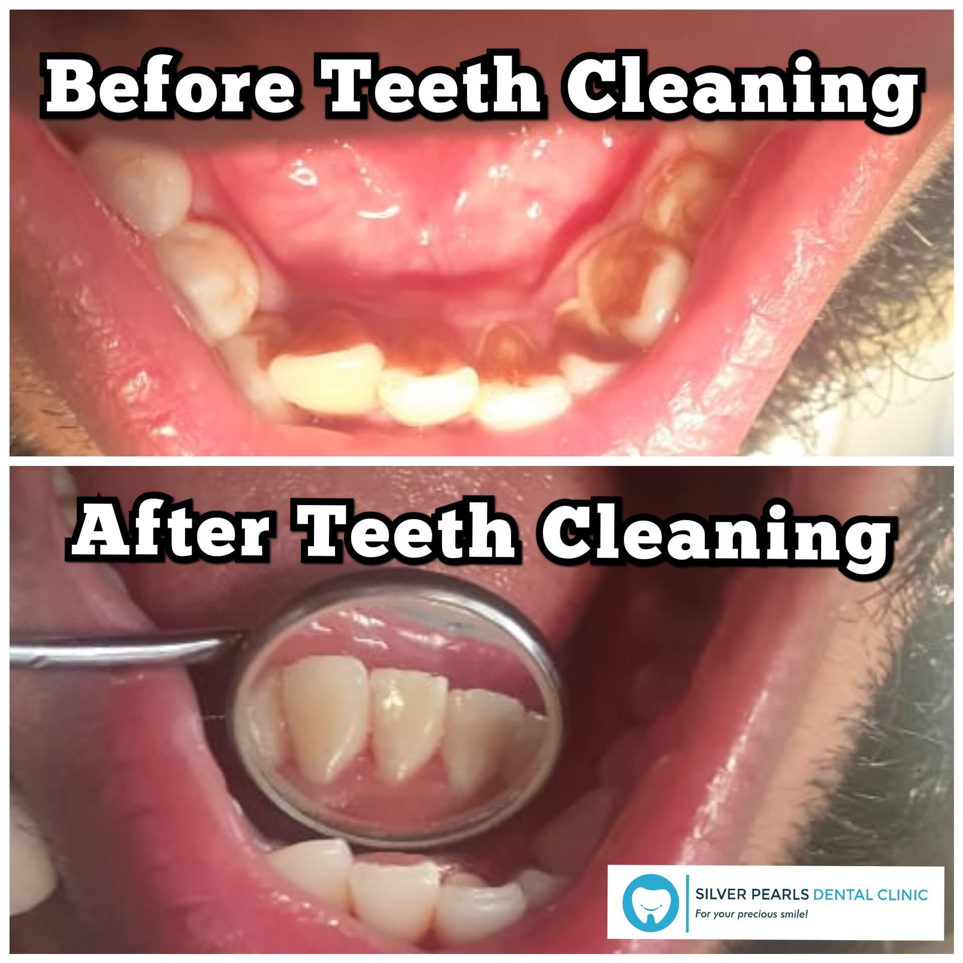 Teeth cleaning treatment by the dentist in Kothrud, Dr. Komal Adsool.