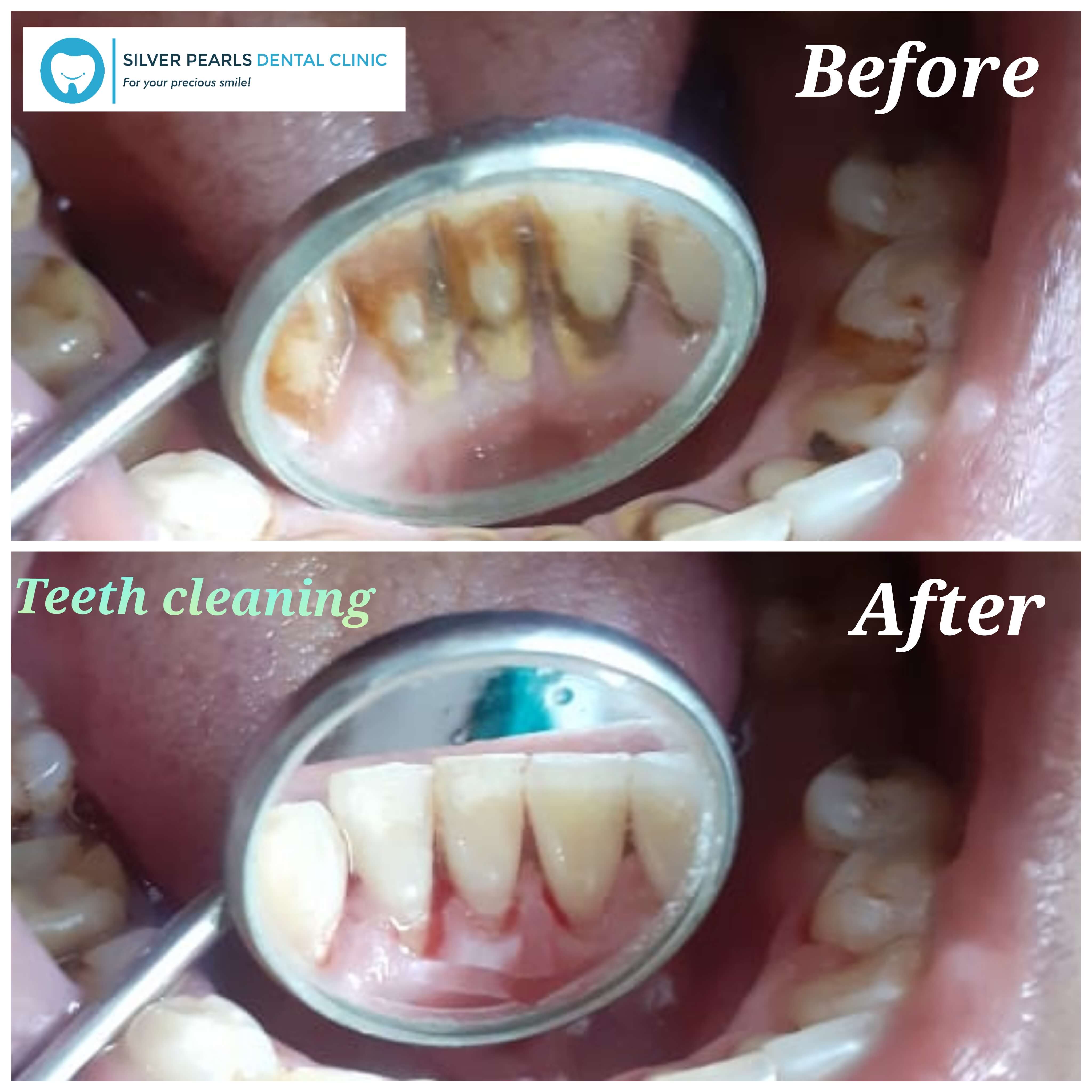 If teeth cleaning is not done regularly, then there is possibility to lead gum infection (gingivitis) and bone loss (periodontitis).
