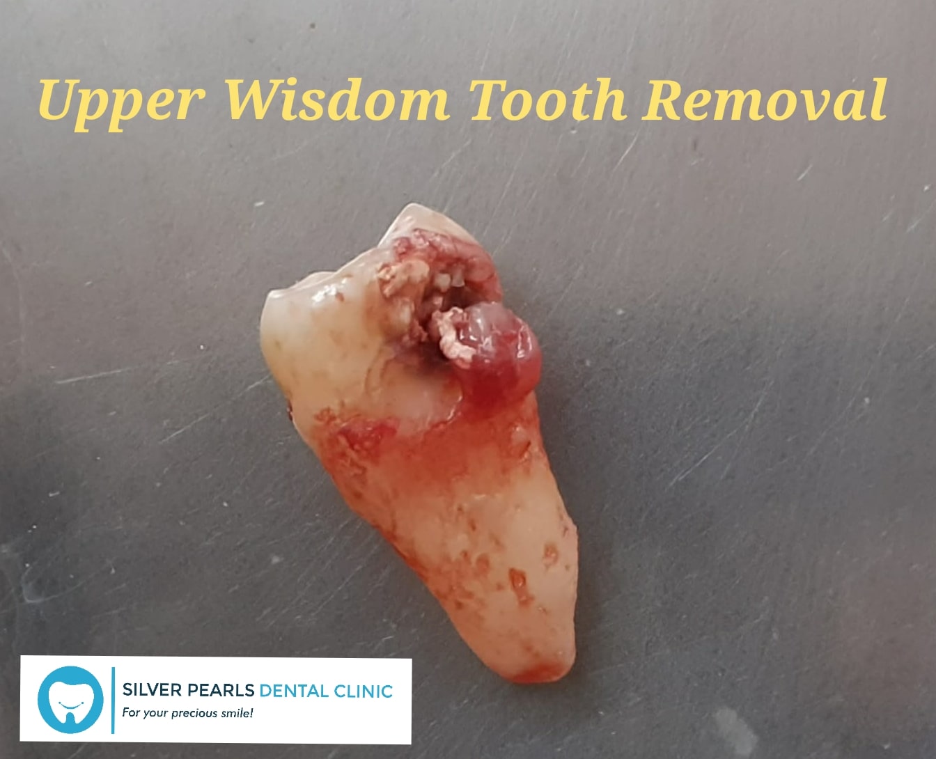 Wisdom tooth can cause cavities or caries and hence the food lodgment, infection, gum disease, swelling on face, pain upon chewing and difficulty in opening the mouth. If you are having any of the symptoms, please visit your dentist earliest.