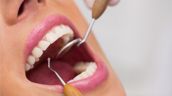 Teeth cleaning at affordable rates in Pune
