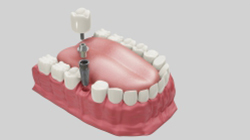 Dental implants in Pune