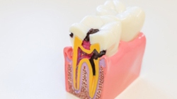 Best root canal treatment in Kothrud