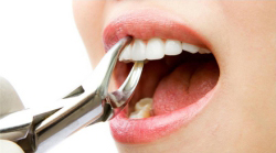 Painless teeth removal & wisdom tooth extraction in Kothrud, Pune