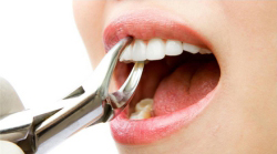 Painless tooth extractions in Kothrud at affordable rates