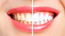 Chepeast teeth whitening services provider Dental clinic in Kothrud